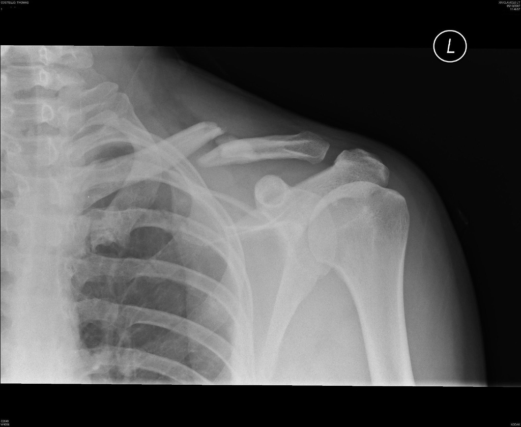 Broken Collar Bone X-Ray